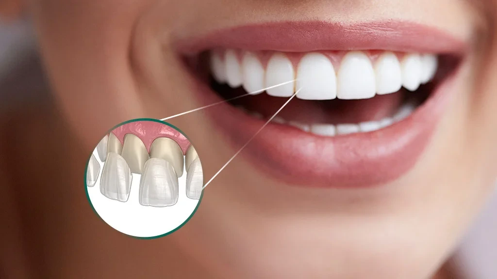 lente dental