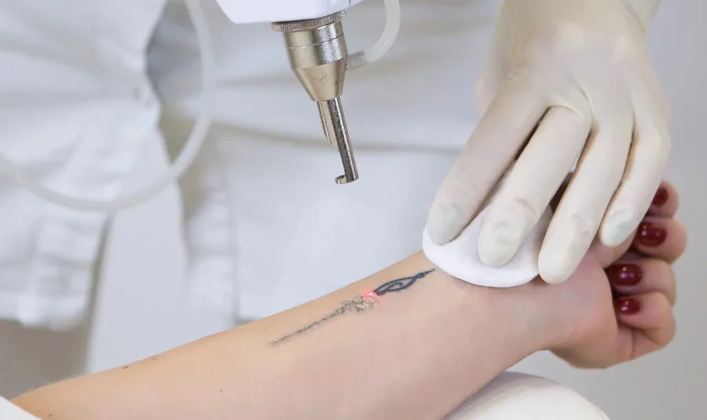 remocao_de_tatuagem_em_curitiba